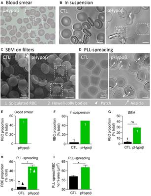 Impaired Cytoskeletal and Membrane Biophysical Properties of Acanthocytes in Hypobetalipoproteinemia – A Case Study